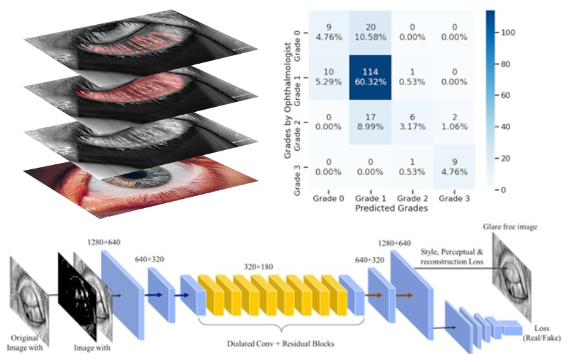 Tear Film Diagnosis with Deep Learning